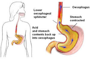 Obat Asam Lambung Naik Ke Tenggorokan